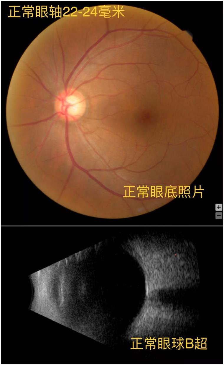 2025-6-13杭州新闻（杭州日报）：不让高度近视人士献血，其实是一种保护（傅映晖）1.jpg