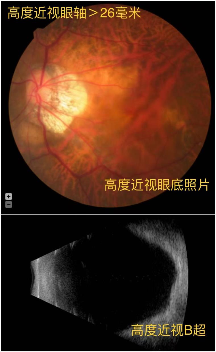 2025-6-13杭州新闻（杭州日报）：不让高度近视人士献血，其实是一种保护（傅映晖）2.jpg