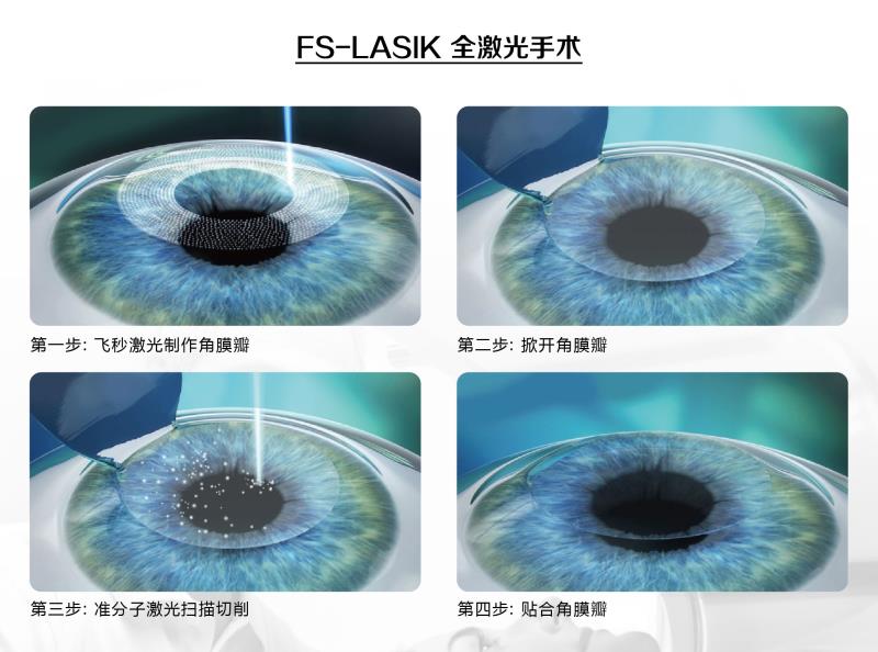 FS-Lasik.jpg